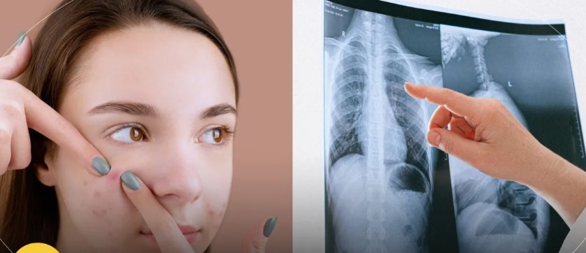 危險三角區 擠痘痘 肺部穿洞 敗血症